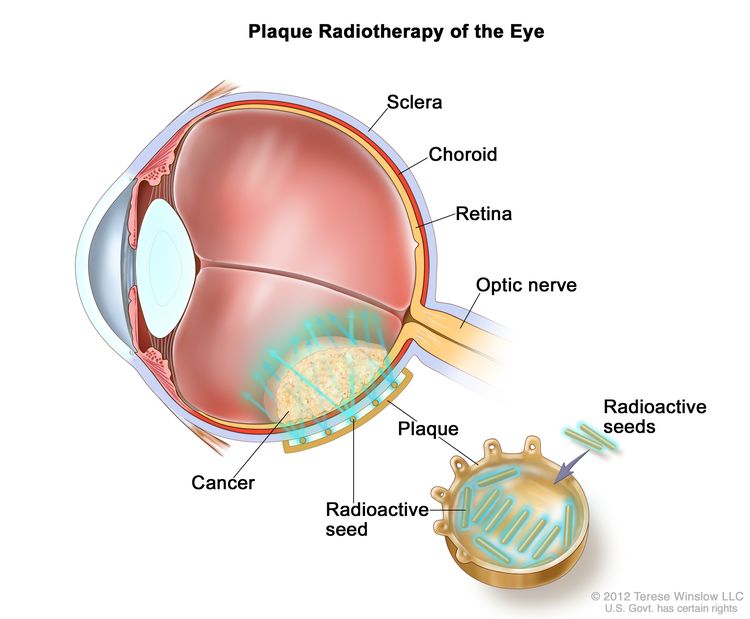 Drawing of a cross-section of the eye showing the sclera, choroid, retina, and optic nerve. An inset shows a plaque with radioactive seeds that is placed on the outside of the eye. The seeds are aimed at the cancer. Drawing of a cross-section of the eye showing the sclera, choroid, retina, and optic nerve. An inset shows a plaque with radioactive seeds that is placed on the outside of the eye. The seeds are aimed at the cancer.