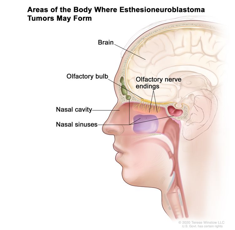 Drawing shows areas of the body where esthesioneuroblastoma tumors may form, including the olfactory nerve endings, olfactory bulb, nasal cavity, nasal sinuses, and brain. Drawing shows areas of the body where esthesioneuroblastoma tumors may form, including the olfactory nerve endings, olfactory bulb, nasal cavity, nasal sinuses, and brain.